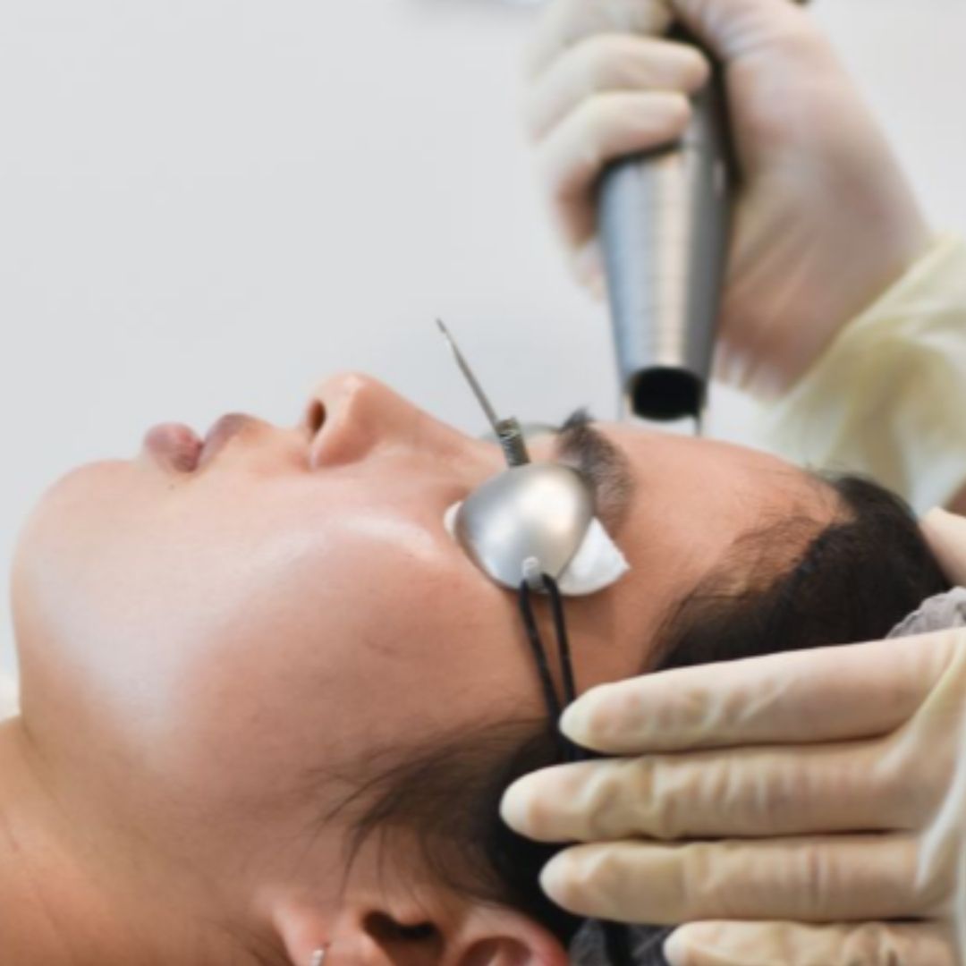 Pico laser skin brightening